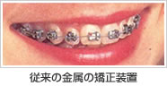 従来の金属の矯正装置