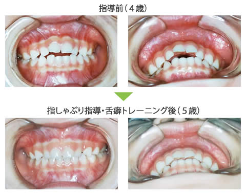 指しゃぶり 舌の癖 船橋市の矯正歯科専門 かねもと矯正歯科