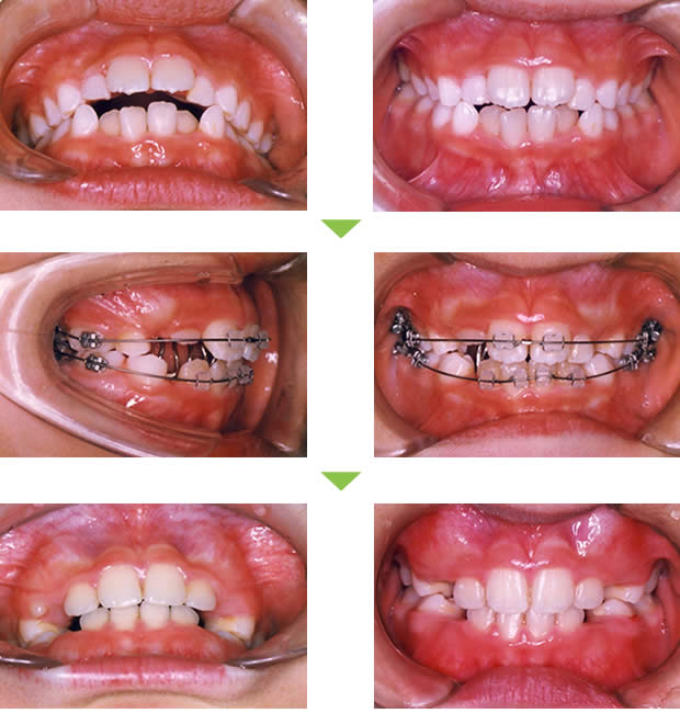 べろガード（フェンス）を併用した矯正治療例