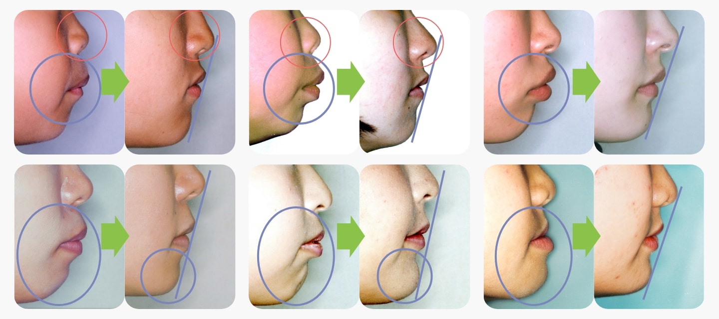 矯正治療例イメージ